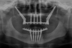 impianti zigomatici albania